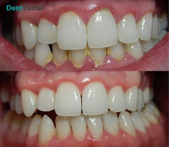 Dental Plaque Info